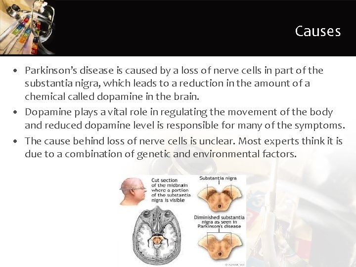 Causes • Parkinson’s disease is caused by a loss of nerve cells in part