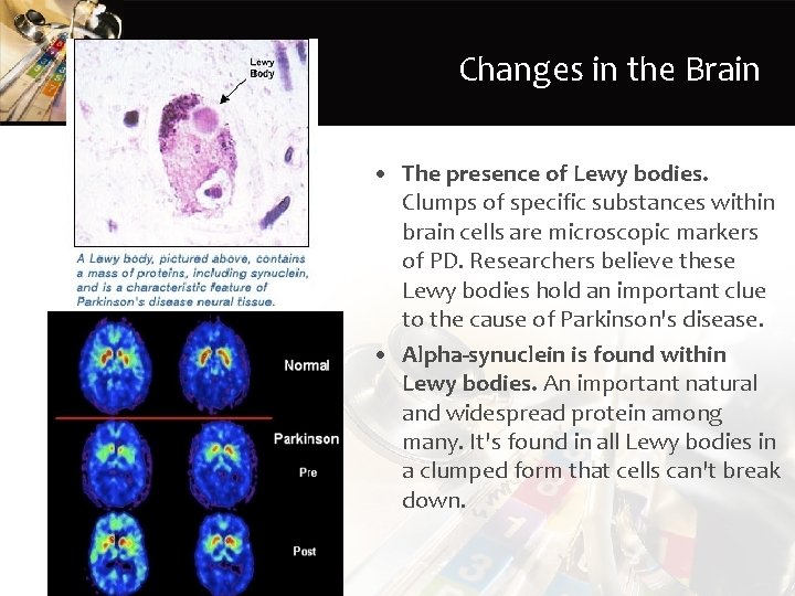 Changes in the Brain • The presence of Lewy bodies. Clumps of specific substances