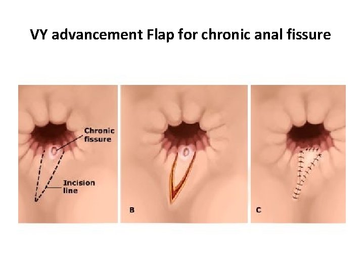 VY advancement Flap for chronic anal fissure 