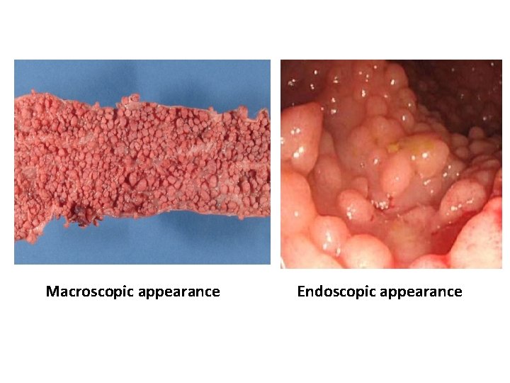 Macroscopic appearance Endoscopic appearance 