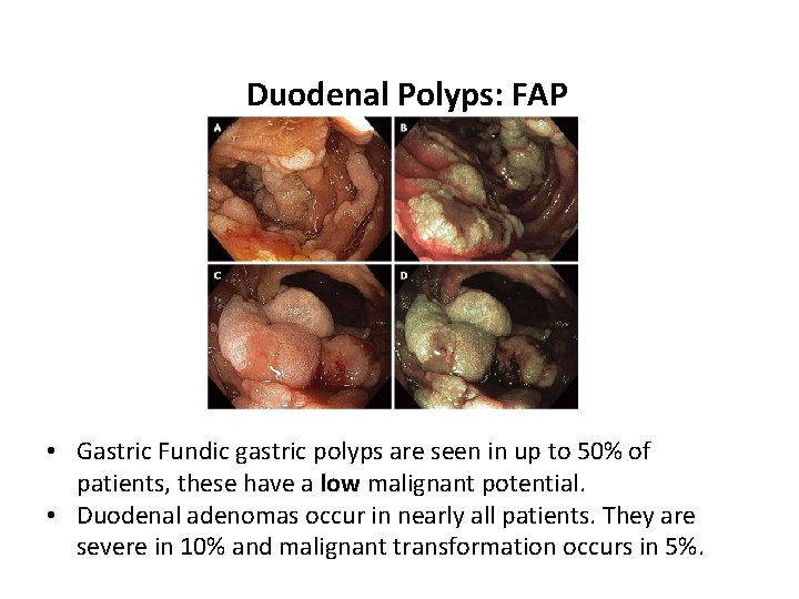 Duodenal Polyps: FAP • Gastric Fundic gastric polyps are seen in up to 50%