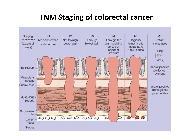 TNM Staging of colorectal cancer 