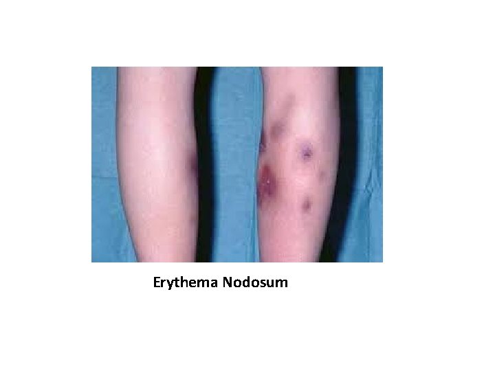 Erythema Nodosum 