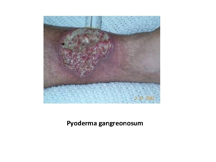 Pyoderma gangreonosum 