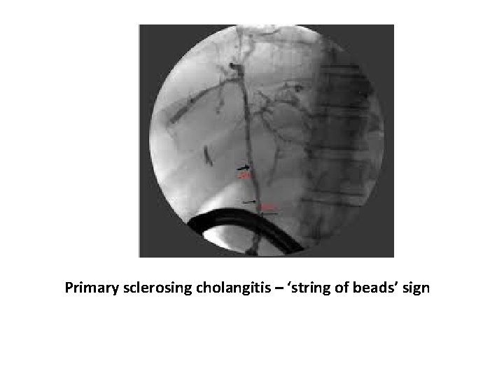 Primary sclerosing cholangitis – ‘string of beads’ sign 