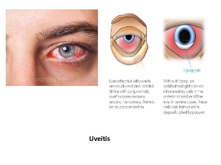 Uveitis 