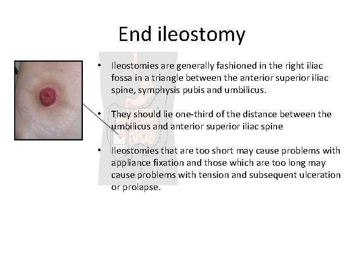 End ileostomy • Ileostomies are generally fashioned in the right iliac fossa in a