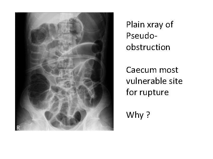 Plain xray of Pseudoobstruction Caecum most vulnerable site for rupture Why ? 