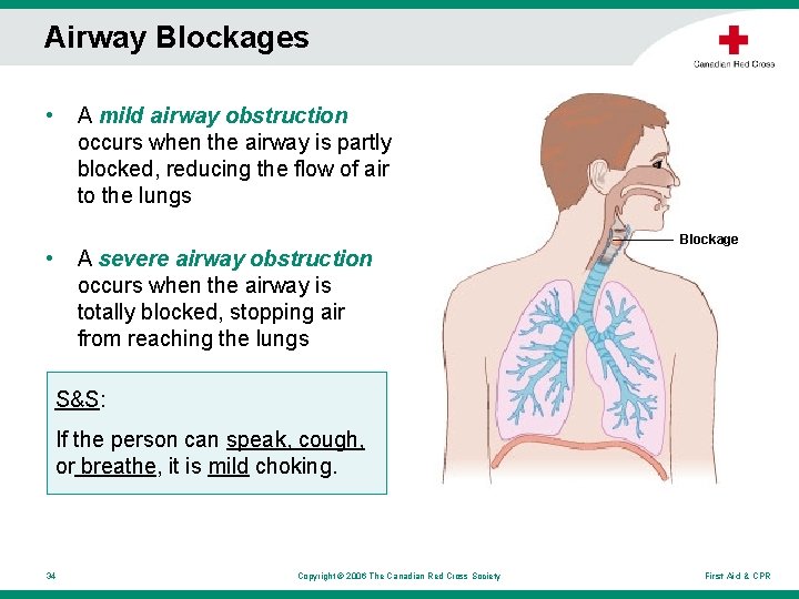 Airway Blockages • A mild airway obstruction occurs when the airway is partly blocked, Airway Blockages • A mild airway obstruction occurs when the airway is partly blocked,