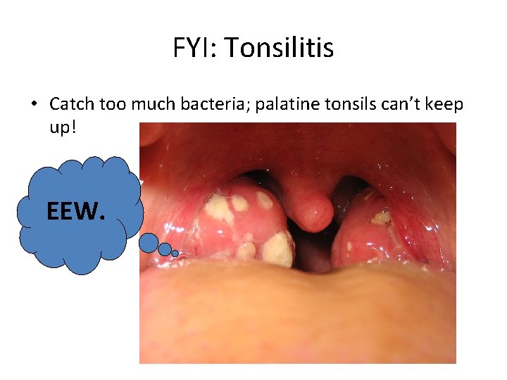 FYI: Tonsilitis • Catch too much bacteria; palatine tonsils can’t keep up! EEW. 