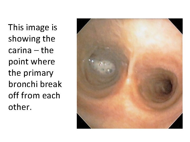 This image is showing the carina – the point where the primary bronchi break