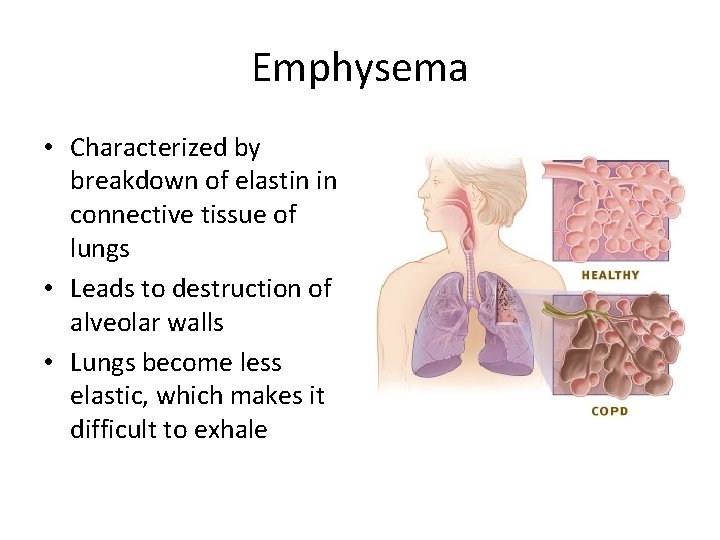 Emphysema • Characterized by breakdown of elastin in connective tissue of lungs • Leads Emphysema • Characterized by breakdown of elastin in connective tissue of lungs • Leads