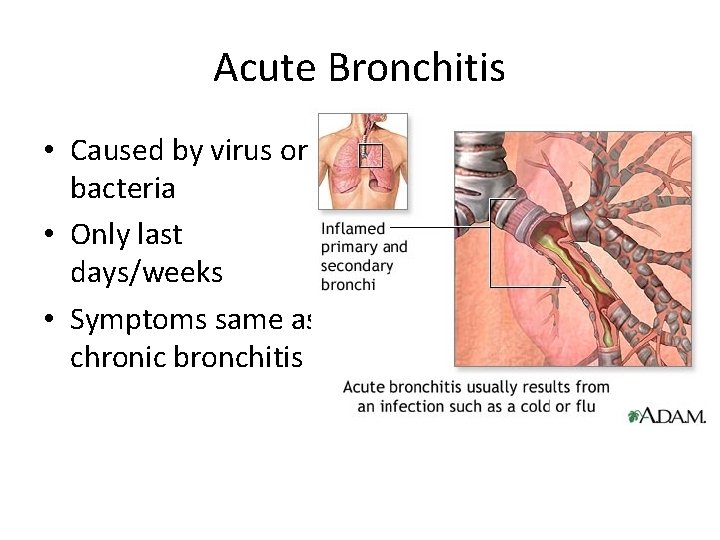 Acute Bronchitis • Caused by virus or bacteria • Only last days/weeks • Symptoms