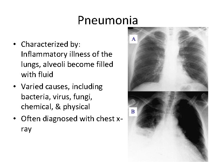 Pneumonia • Characterized by: Inflammatory illness of the lungs, alveoli become filled with fluid