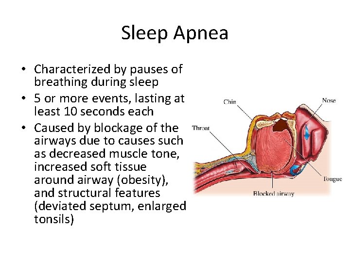 Sleep Apnea • Characterized by pauses of breathing during sleep • 5 or more