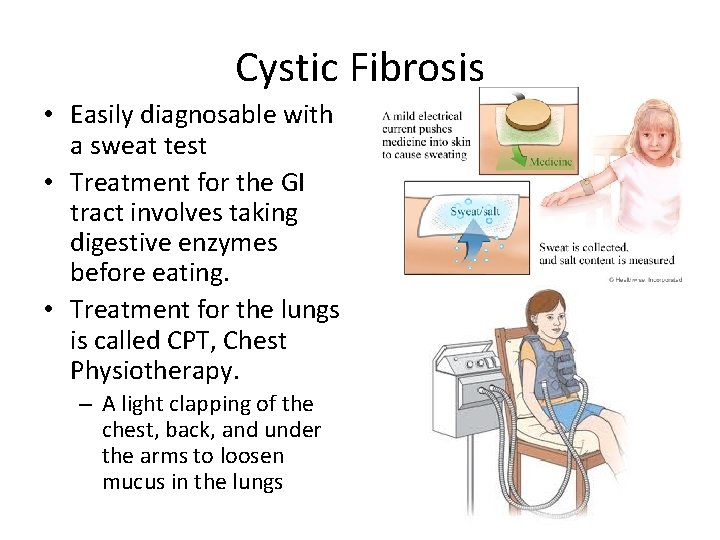 Cystic Fibrosis • Easily diagnosable with a sweat test • Treatment for the GI