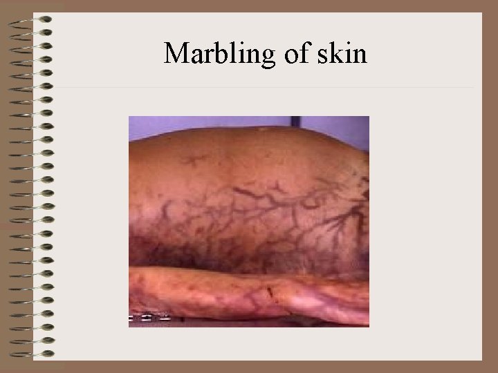 Marbling of skin 