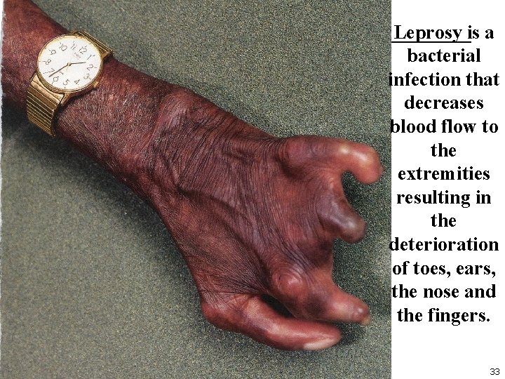 Leprosy is a bacterial infection that decreases blood flow to the extremities resulting in
