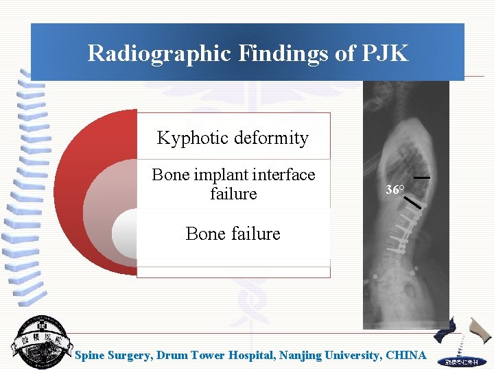 Radiographic Findings of PJK Kyphotic deformity Bone implant interface failure 36° Bone failure Spine