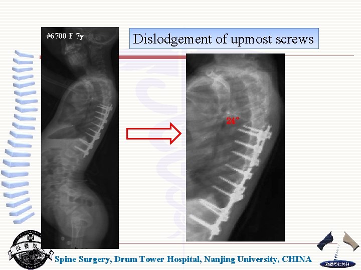 #6700 F 7 y Dislodgement of upmost screws 24° Spine Surgery, Drum Tower Hospital,