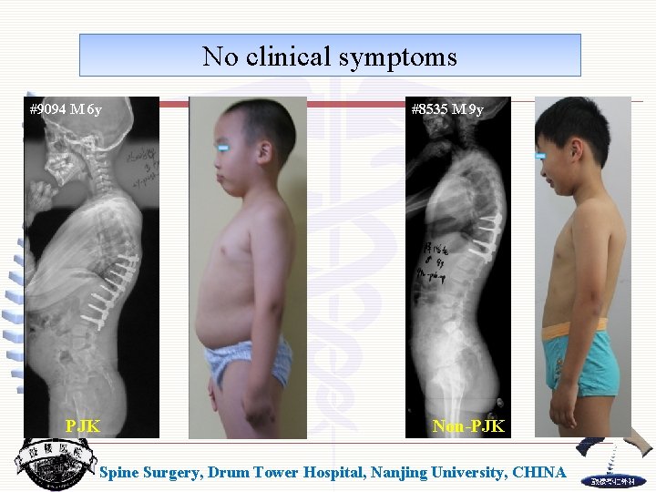 No clinical symptoms #9094 M 6 y PJK #8535 M 9 y Non-PJK Spine