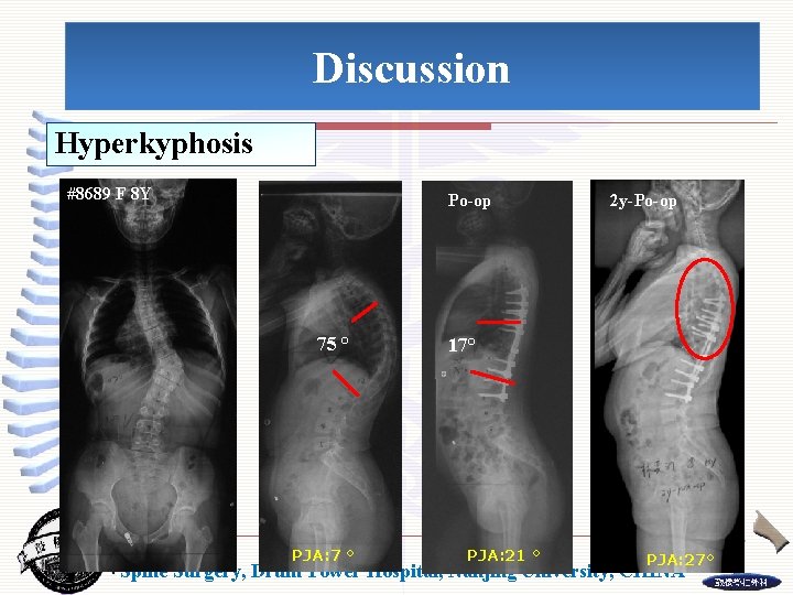 Discussion Hyperkyphosis #8689 F 8 Y Po-op 75 ° PJA: 7 ° 2 y-Po-op