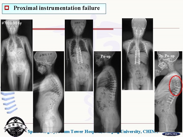 p Proximal instrumentation failure #7021 M 6 y Po-op Spine Surgery, Drum Tower Hospital,