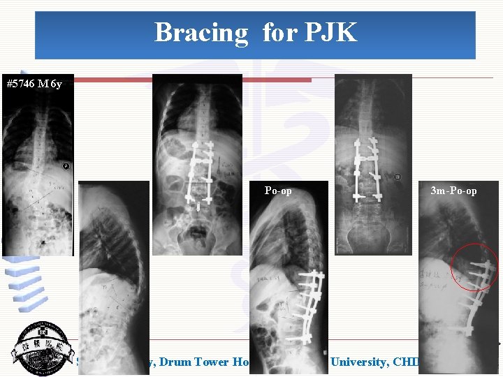 Bracing for PJK #5746 M 6 y Po-op 3 m-Po-op Spine Surgery, Drum Tower