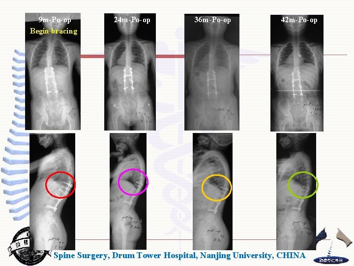 9 m-Po-op Begin bracing 24 m-Po-op 36 m-Po-op 42 m-Po-op Spine Surgery, Drum Tower