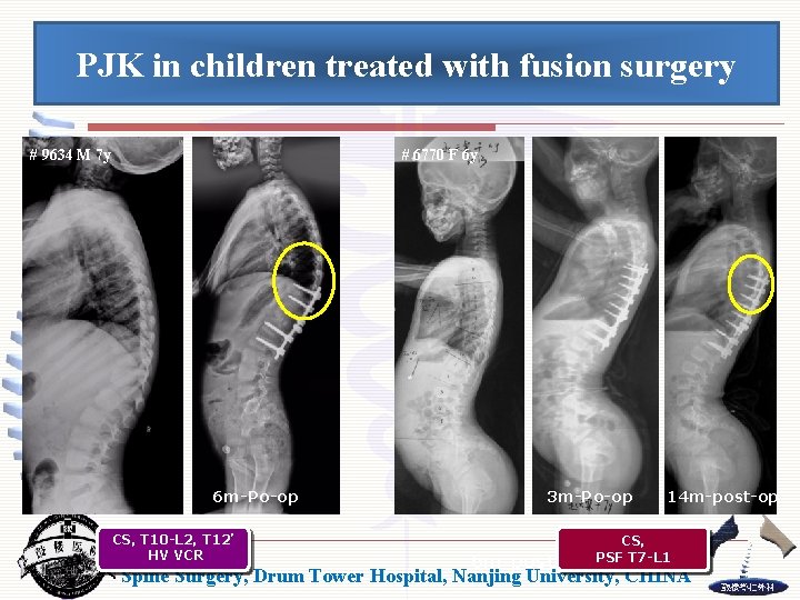 PJK in children treated with fusion surgery # 9634 M 7 y # 6770