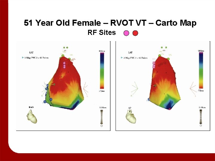Pvc Rvot Map Carto Ventricular Arrhythmias When to Reassure When to Refer