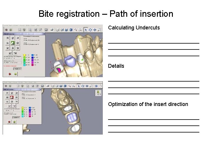 Bite registration – Path of insertion Calculating Undercuts _______________________________ Details _______________________________ Optimization of the