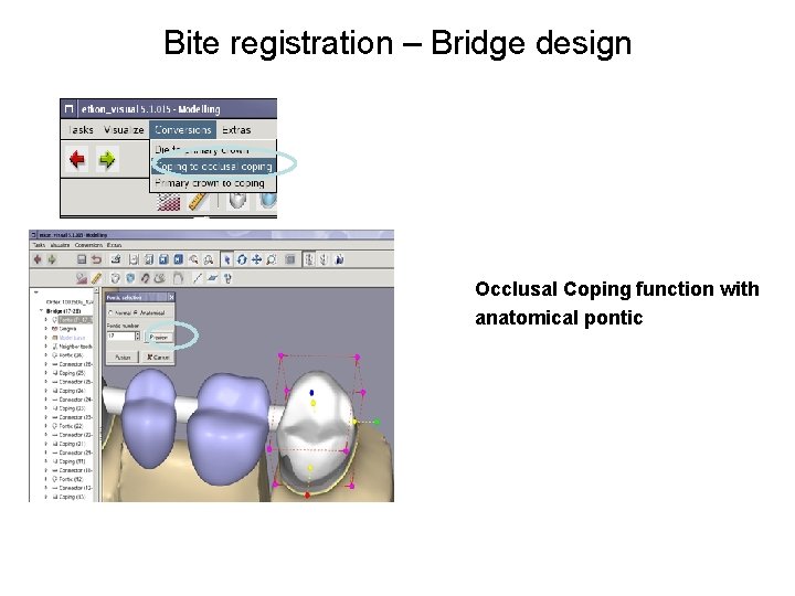 Bite registration – Bridge design Occlusal Coping function with anatomical pontic 