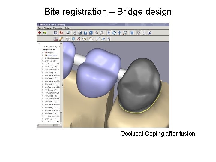 Bite registration – Bridge design Occlusal Coping after fusion 