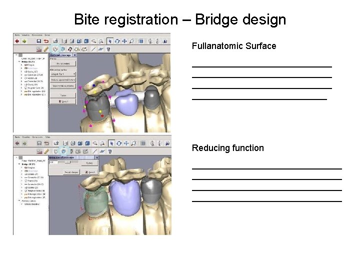 Bite registration – Bridge design Fullanatomic Surface ____________________________ ______________ Reducing function ______________________________ 