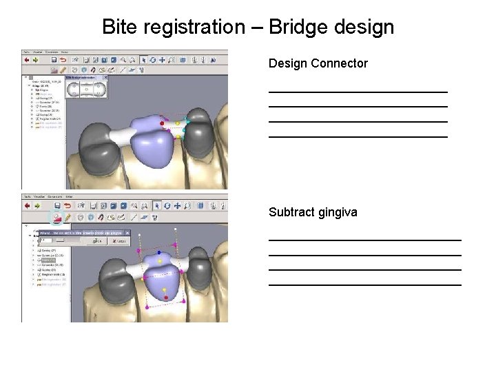 Bite registration – Bridge design Design Connector __________________________ Subtract gingiva ____________________________ 