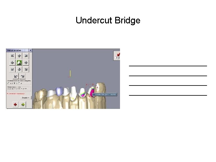 Undercut Bridge __________________________ 