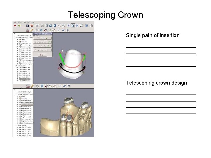 Telescoping Crown Single path of insertion ________________________ Telescoping crown design ________________________ 