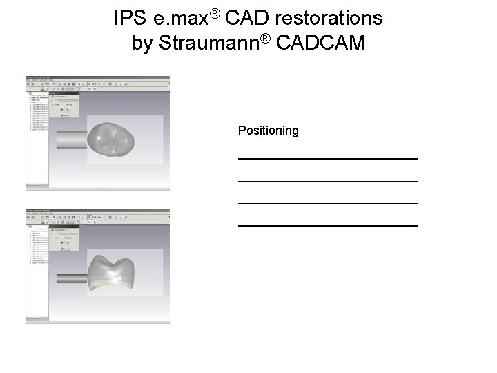 IPS e. max® CAD restorations by Straumann® CADCAM Positioning __________________________ 