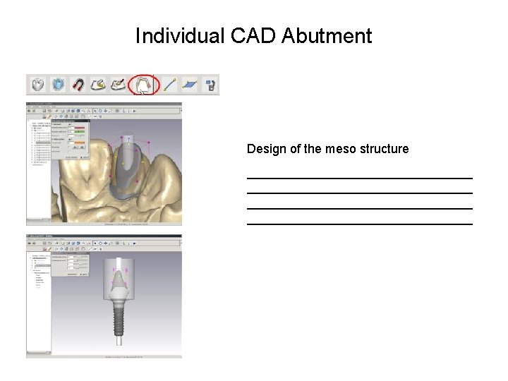 Individual CAD Abutment Design of the meso structure ________________________________ 