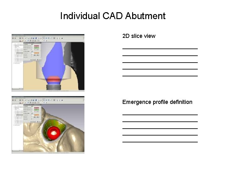 Individual CAD Abutment 2 D slice view ________________________ ____________ Emergence profile definition ________________________ ____________