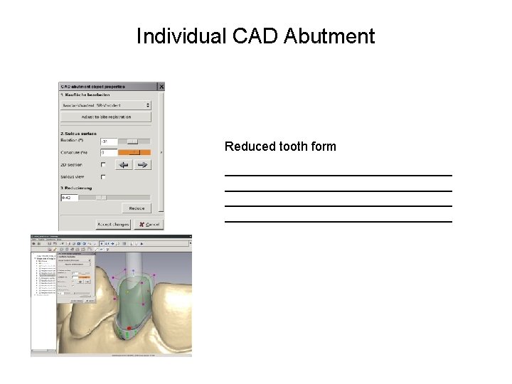 Individual CAD Abutment Reduced tooth form ________________________________ 