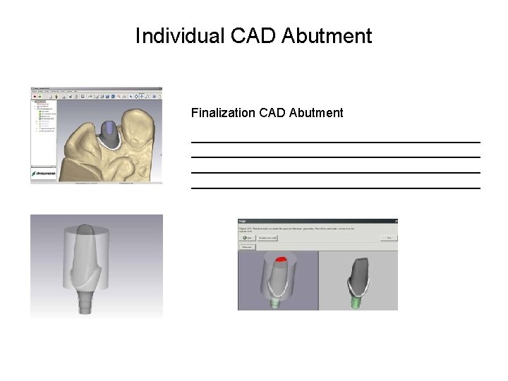 Individual CAD Abutment Finalization CAD Abutment _________________________________________ 