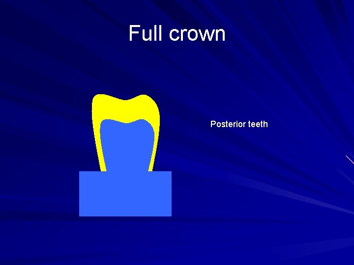 Full crown Posterior teeth 