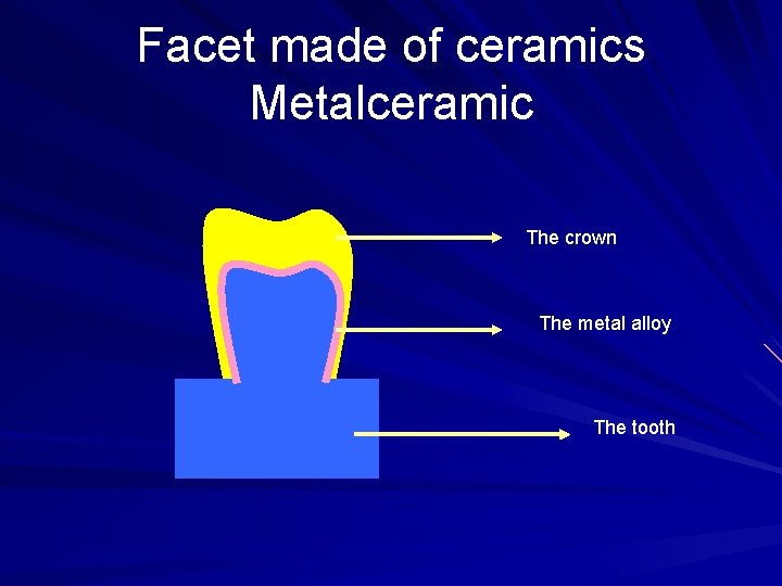 Facet made of ceramics Metalceramic The crown The metal alloy The tooth 