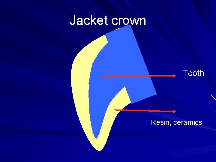 Jacket crown Tooth Resin, ceramics 