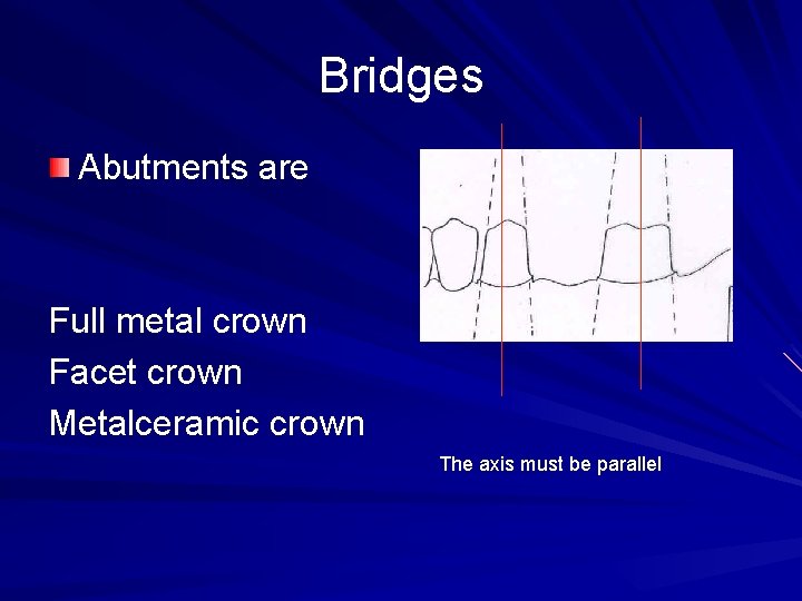 Bridges Abutments are Full metal crown Facet crown Metalceramic crown The axis must be
