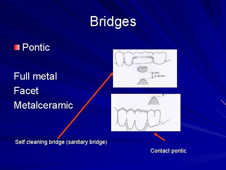 Bridges Pontic Full metal Facet Metalceramic Self cleaning bridge (sanitary bridge) Contact pontic 