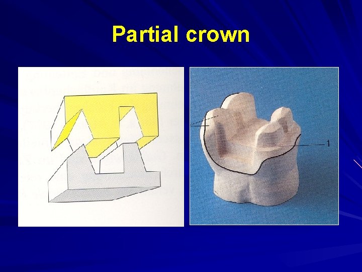 Partial crown 