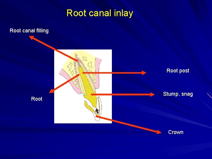 Root canal inlay Root canal filling Root post Root Stump, snag Crown 